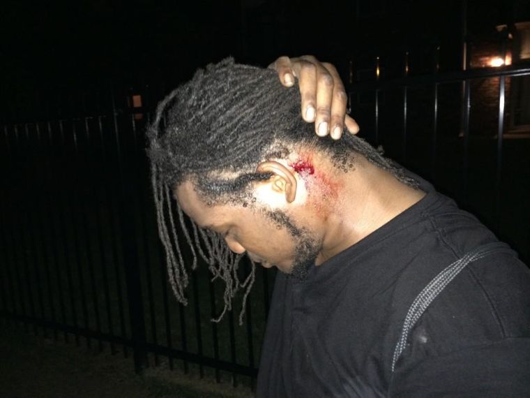 A young man shows reporters where a rubber bullet fired by Ferguson police injured him.